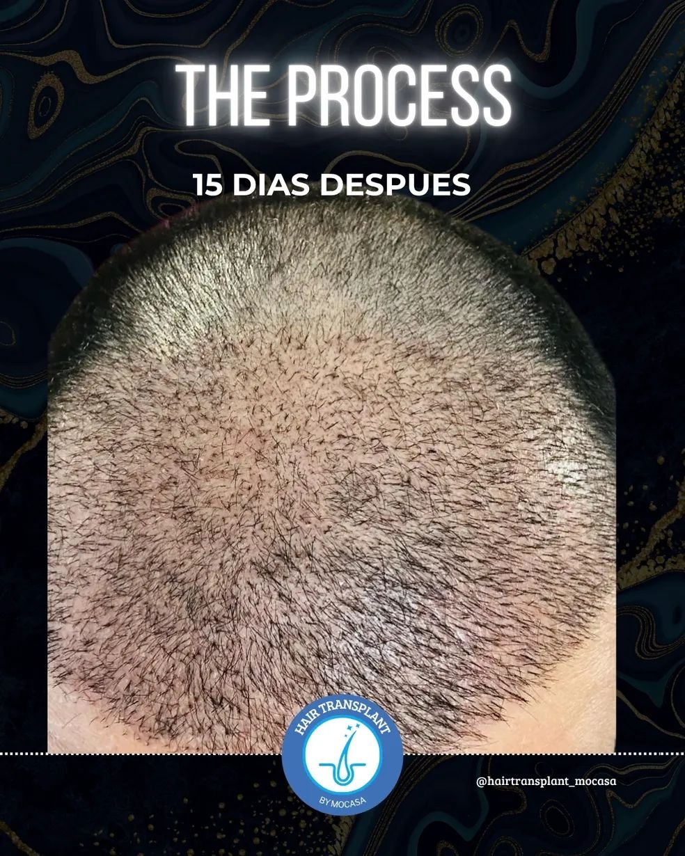 Hair transplant before and after result 1