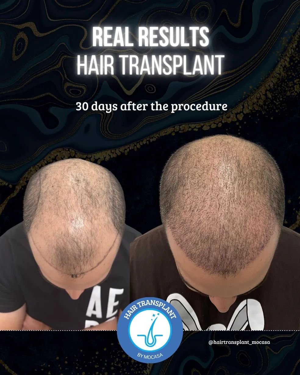 Hair transplant before and after result 3