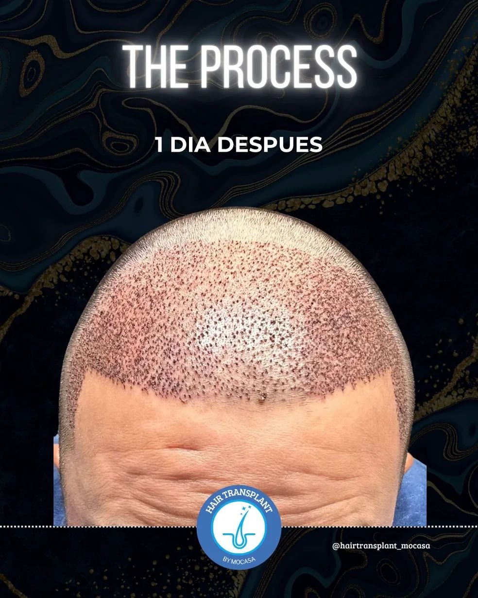 Hair transplant before and after result 4