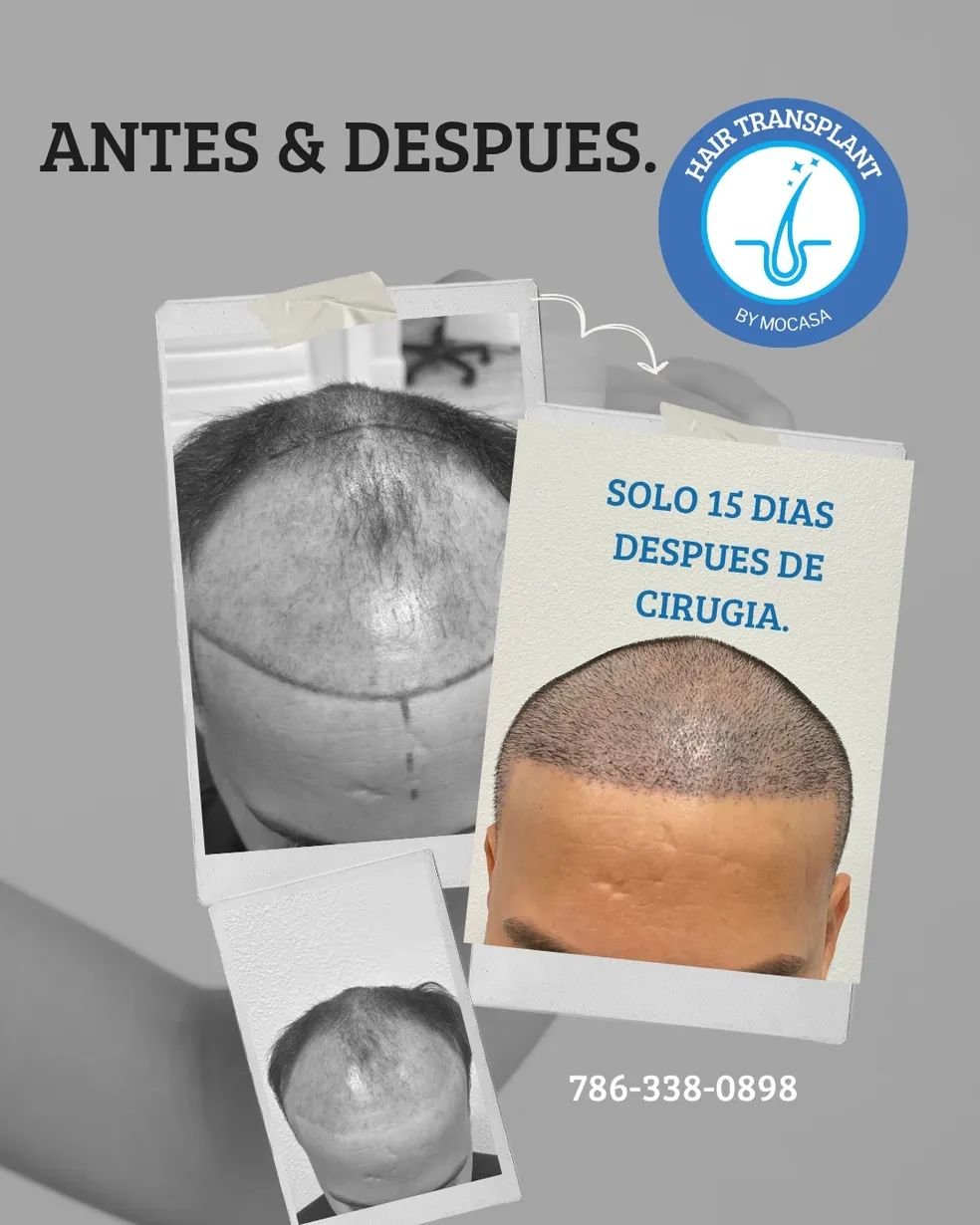 Hair transplant before and after result 6